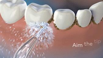 洗牙神器是真的管用,洗牙神器去牙结石永久有效果