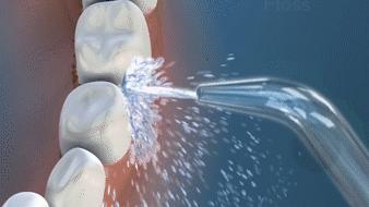 洗牙神器是真的管用,洗牙神器去牙结石永久有效果