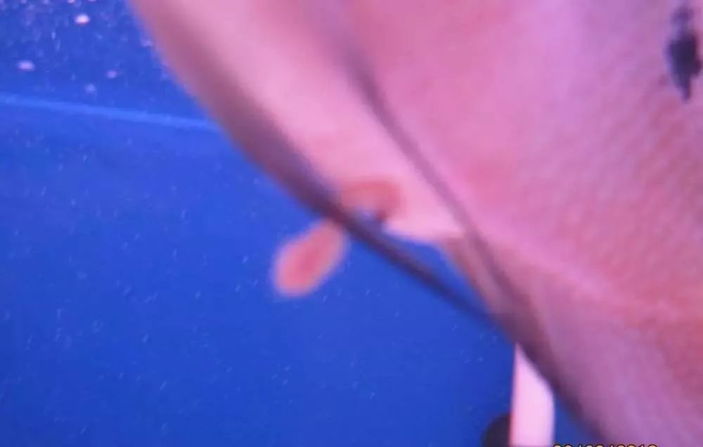 梭菌性肠炎的症状用什么药治疗,慢性肠炎怎么治疗好能彻底去根