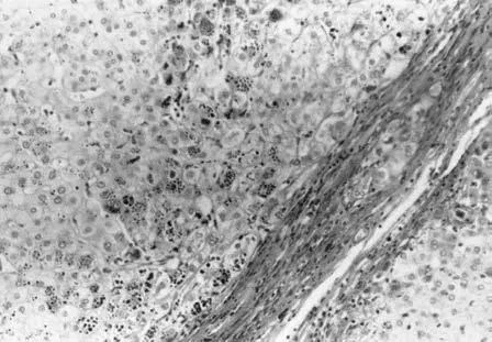 肝功能异常待查？莫忽视这一疾病的筛查！｜温故知新