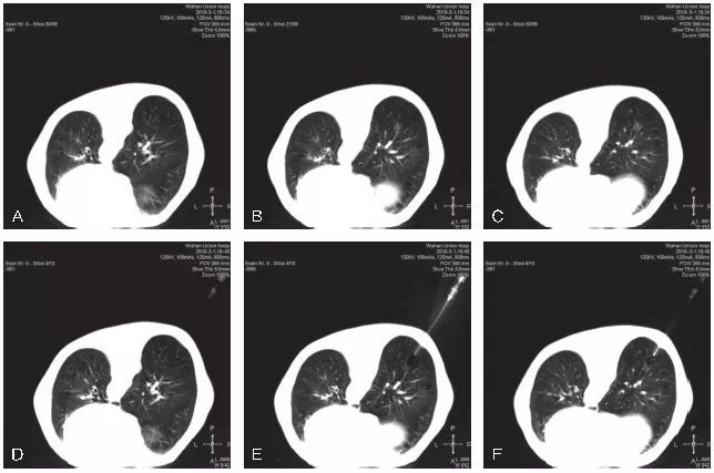 穿刺活检标本包埋切片的注意事项,小结节穿刺活检