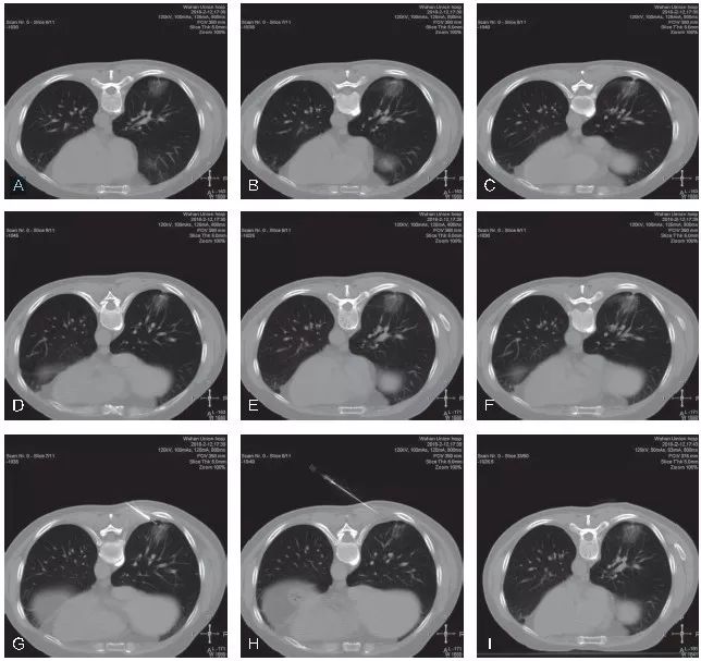 穿刺活检标本包埋切片的注意事项,小结节穿刺活检