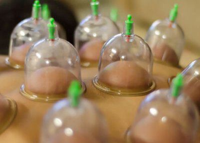 拔罐疗法你了解多少,根治型拔罐疗法书籍