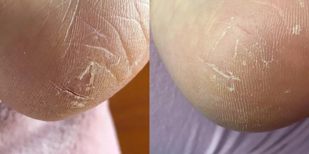 爸妈的手脚布满了老茧,手足干裂是什么前兆