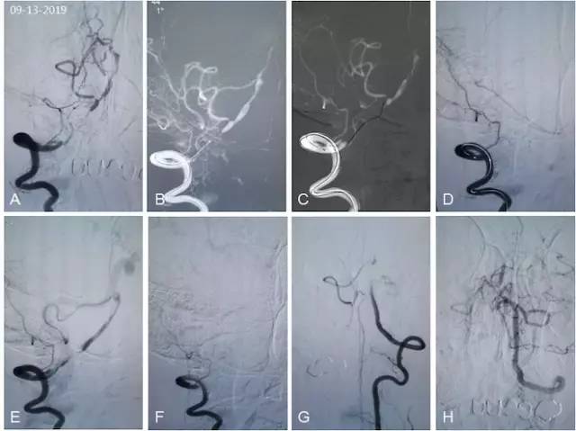 天坛周记·第147期｜右椎动脉V3-4段闭塞血管内介入治疗开通失败1例