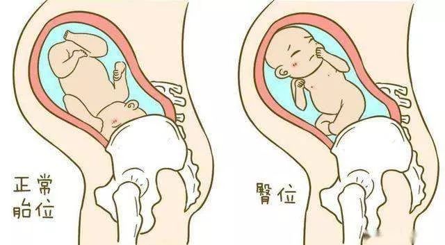 胎儿臀位分娩过程,臀位阴道分娩何时堵臀