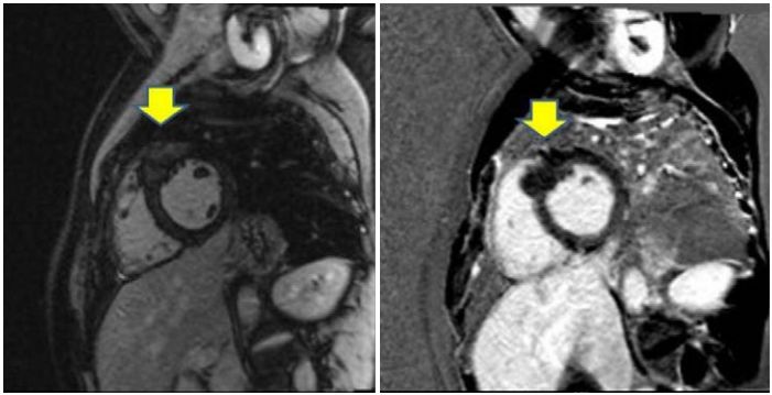 异常q波心电图怎么看图解,异常q波心脏彩超有什么表现