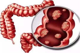 肠息肉为啥春风吹又生？