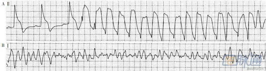 电风暴诊断治疗指南,电风暴疾病