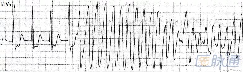 电风暴诊断治疗指南,电风暴疾病