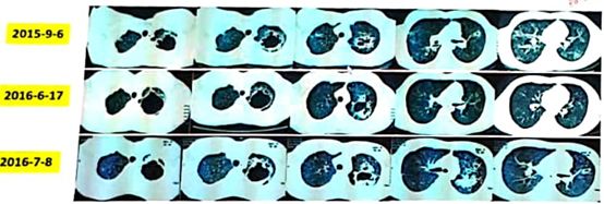 反复呼吸道感染病例分享,呼吸道感染鉴别诊断病例