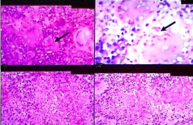 反复呼吸道感染病例分享,呼吸道感染鉴别诊断病例