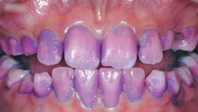 洗牙神器是真的管用,洗牙神器去牙结石永久有效果