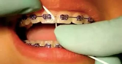 洗牙神器是真的管用,洗牙神器去牙结石永久有效果