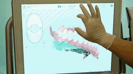 昆明龅牙矫正哪家便宜,长沙成人隐形牙齿矫正龅牙