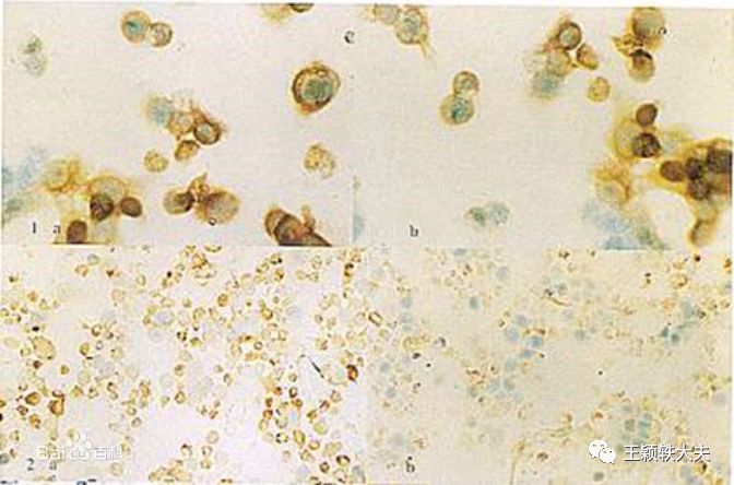 癌症的治疗与预防讲座的心得体会,浅谈肺癌的癌变之路