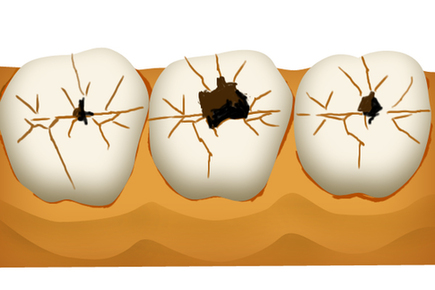 龋齿一直不治疗最坏的结果是怎样,龋齿平常怎么自己使它不恶化