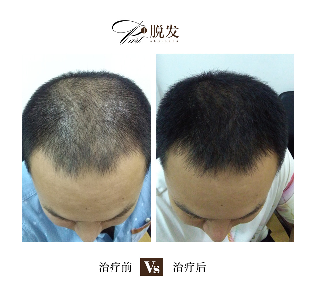 女性脱发连根一起掉严重10个原因,脂溢性脱发是什么原因引起的啊