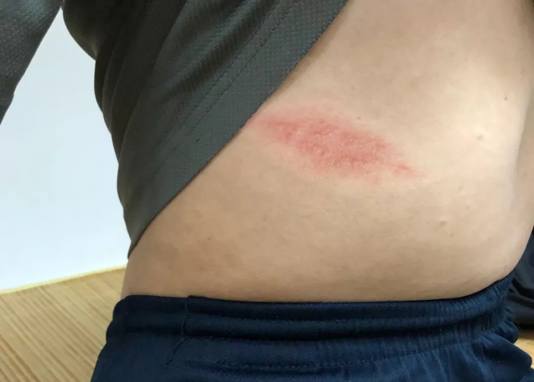 带状疱疹疼痛级数,带状疱疹疼痛看中医