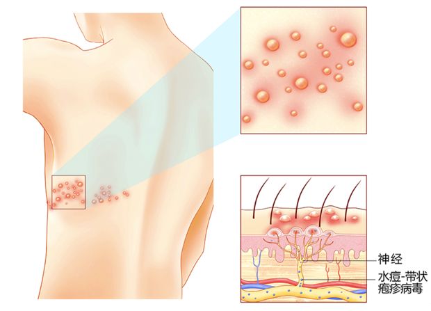 带状疱疹疼痛级数,带状疱疹疼痛看中医