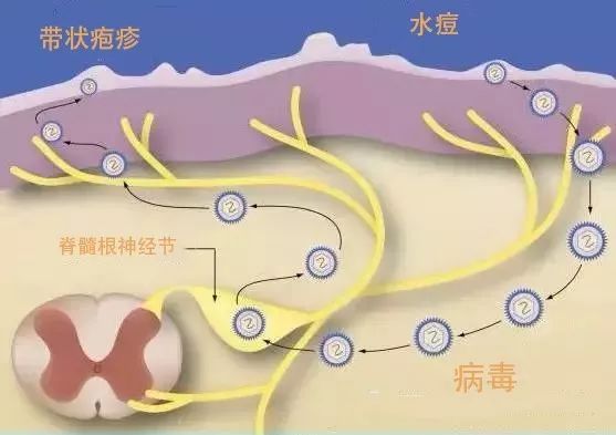 带状疱疹疼痛级数,带状疱疹疼痛看中医