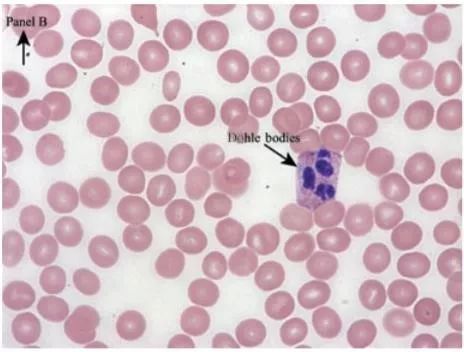 免疫性血小板减少症真不能治了吗,免疫性血小板减少症是不是很可怕