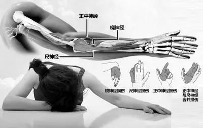 男孩午睡时腿麻倒地后又睡着,睡一觉桡神经损伤