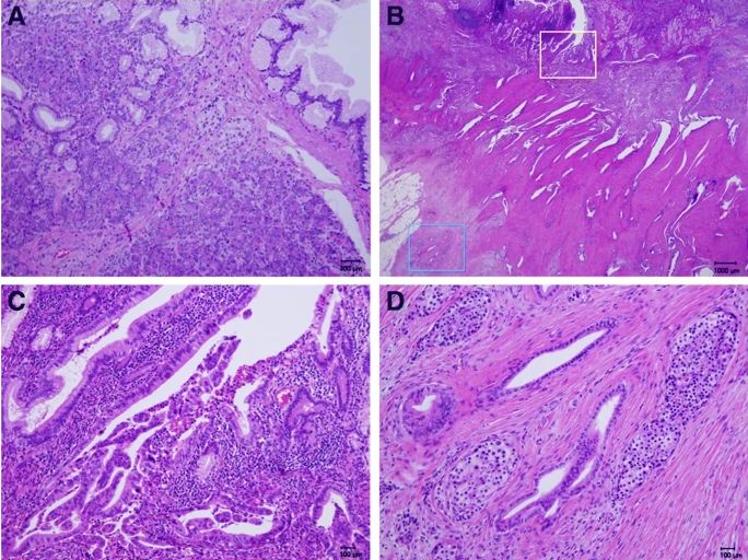 十二指肠腺癌2.5厘米几期,十二指肠癌罕见