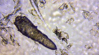 脸上痘痘反反复复毛孔大,痘痘黑头粉刺出油