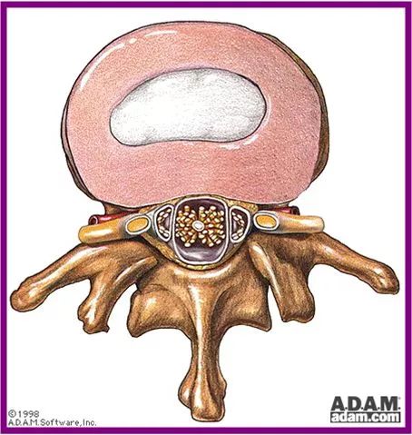 “腰椎间盘突出”怎么办？正确治疗，让你挺直腰板