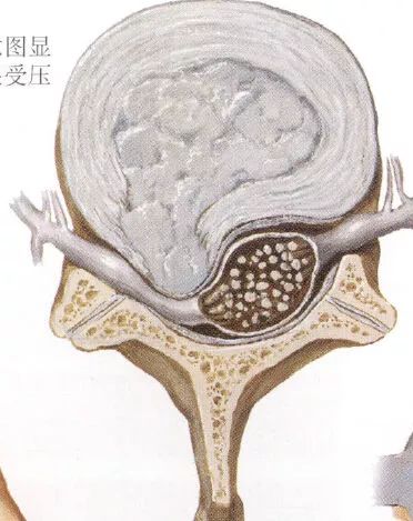 “腰椎间盘突出”怎么办？正确治疗，让你挺直腰板