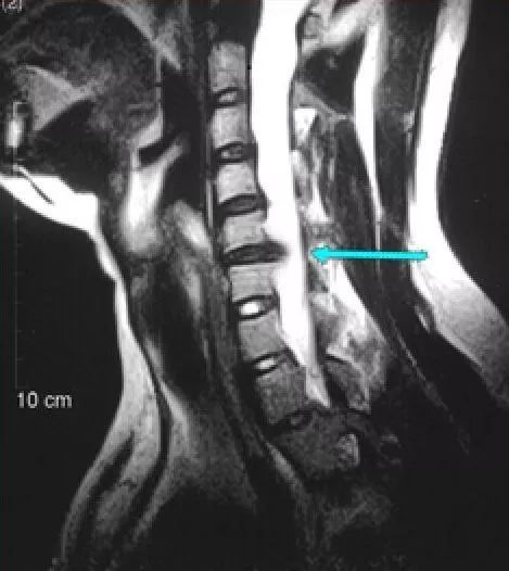 “腰椎间盘突出”怎么办？正确治疗，让你挺直腰板