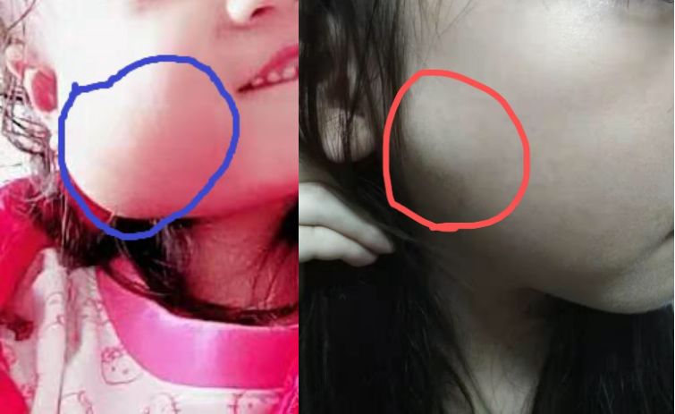 小儿童眼肿瘤,孩子斗鸡眼眼球震颤