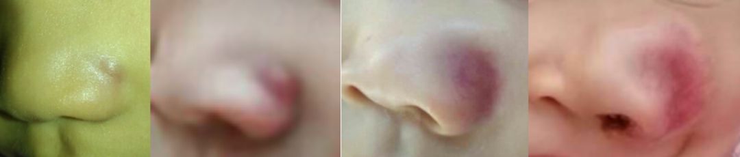 小儿童眼肿瘤,孩子斗鸡眼眼球震颤