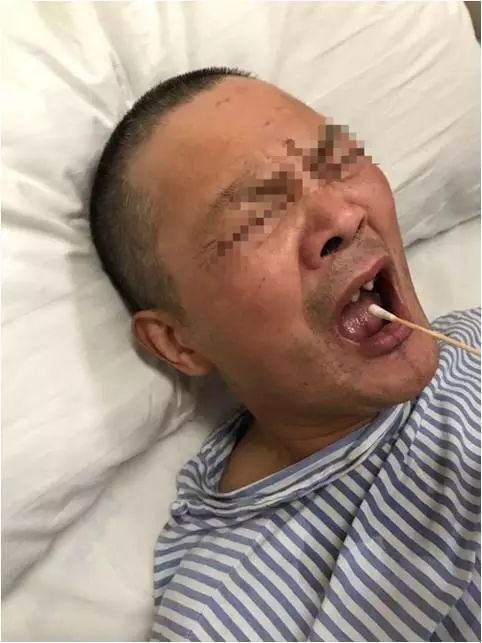 中暑会对大脑造成不可逆的损伤,中暑会导致大脑缺氧吗