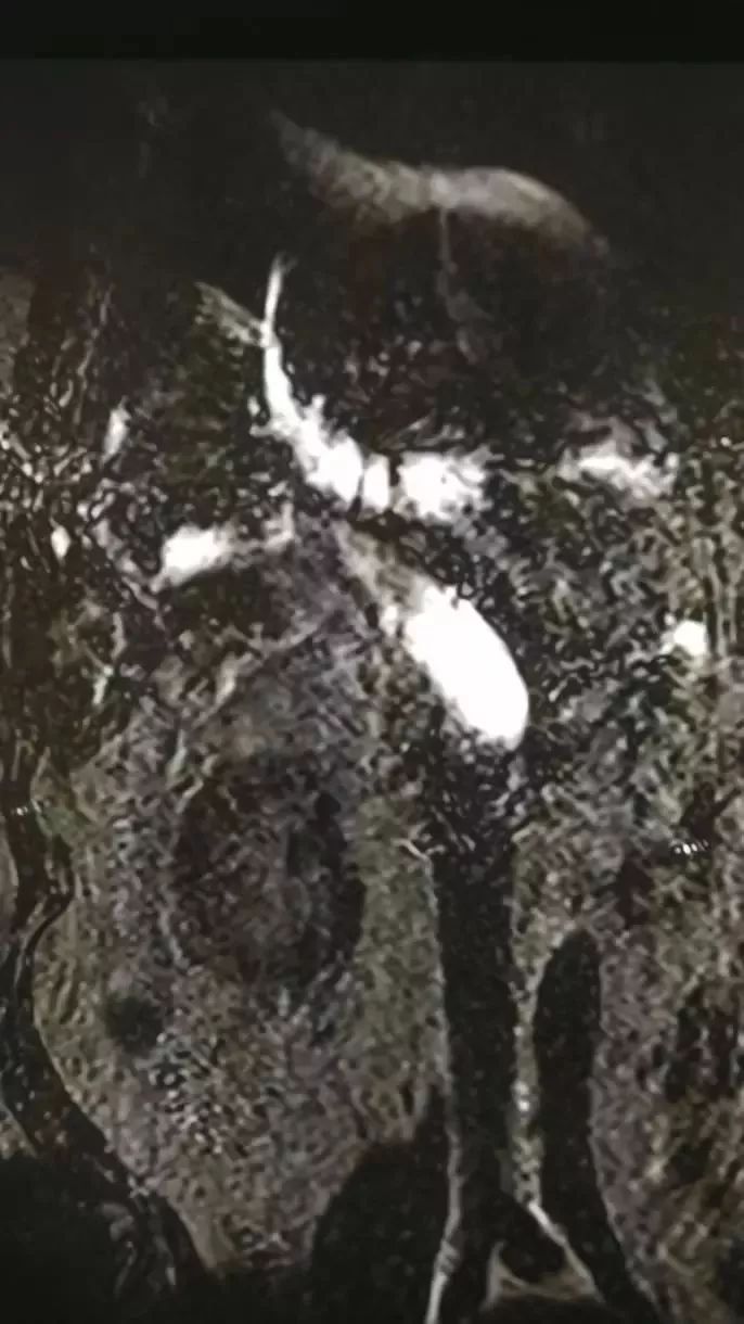 胰腺癌误诊黄疸肝炎,急性黄疸性肝炎住院治疗没效果