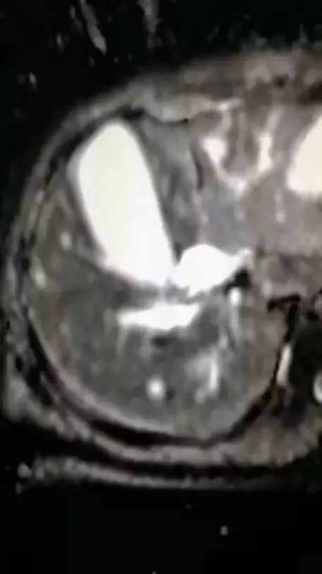 胰腺癌误诊黄疸肝炎,急性黄疸性肝炎住院治疗没效果