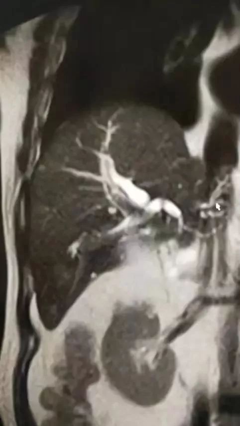 胰腺癌误诊黄疸肝炎,急性黄疸性肝炎住院治疗没效果