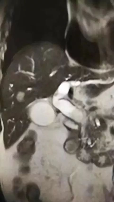 胰腺癌误诊黄疸肝炎,急性黄疸性肝炎住院治疗没效果