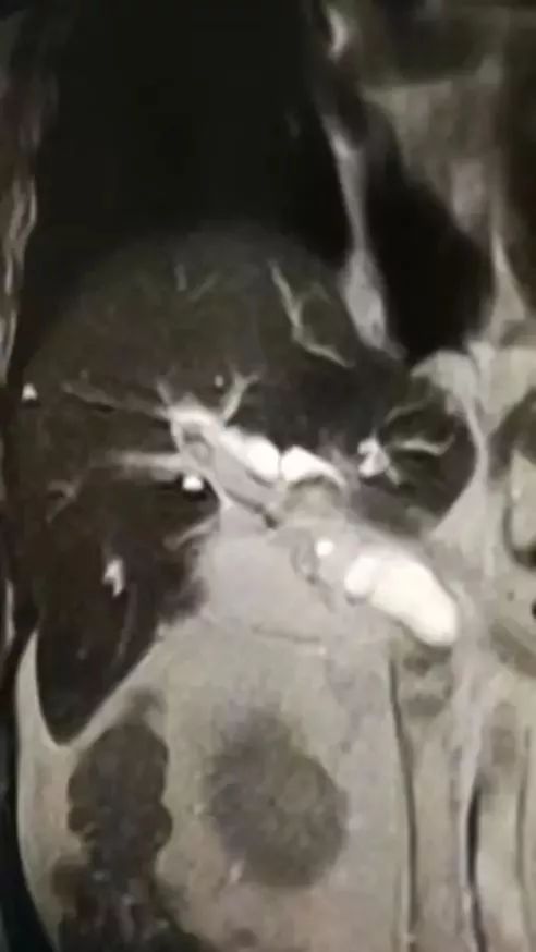 胰腺癌误诊黄疸肝炎,急性黄疸性肝炎住院治疗没效果