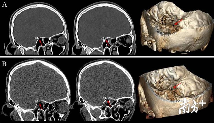 脑外伤引起视力模糊怎样治疗,脑外伤引起视力模糊怎么治疗