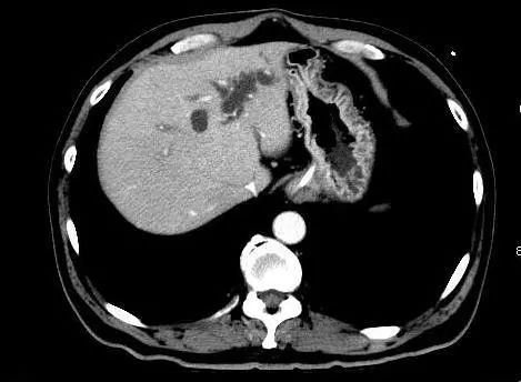 胆汁淤积是左侧还是右侧,胆汁淤积是胆有病还是肝有病