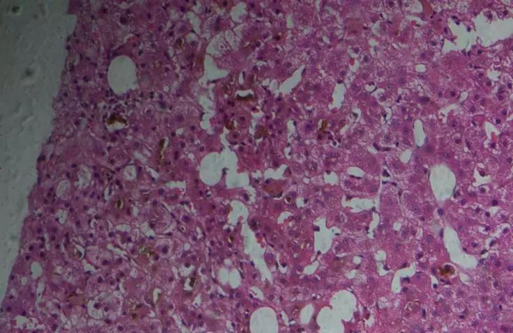 胆汁淤积是左侧还是右侧,胆汁淤积是胆有病还是肝有病