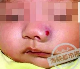 泉州家长注意！孩子身上这个“红胎记”，险些造成左眼失明