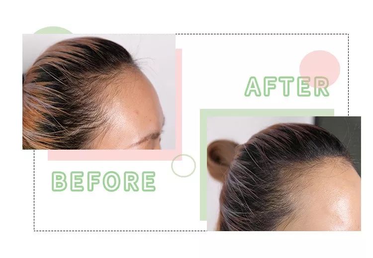 比胖更可怕的竟然是秃头！看完不敢减肥了