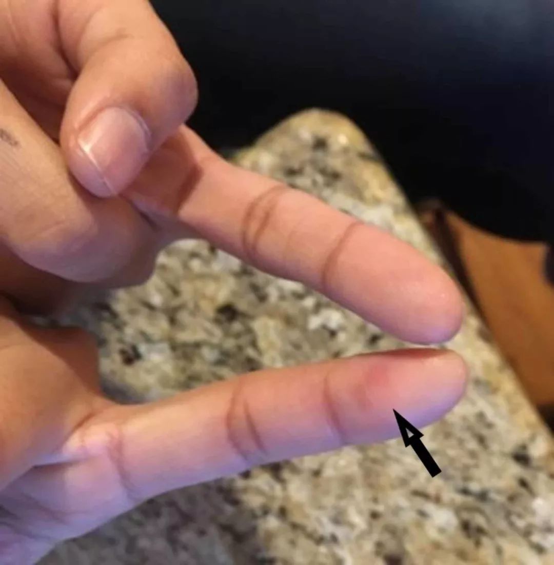 感染性心内膜炎的护理常规记录,新生儿感染性心内膜炎