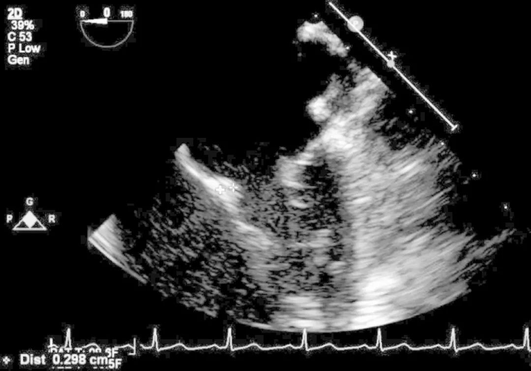 感染性心内膜炎的护理常规记录,新生儿感染性心内膜炎