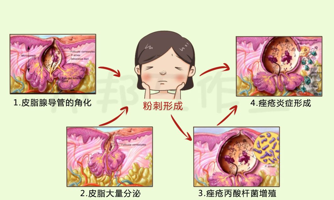 长黑头粉刺该怎么快速去除,鼻子上的黑头特别多该怎么去除