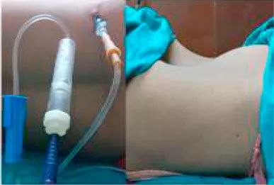 14岁先天肾积水21mm,巨大肾积水形成原因