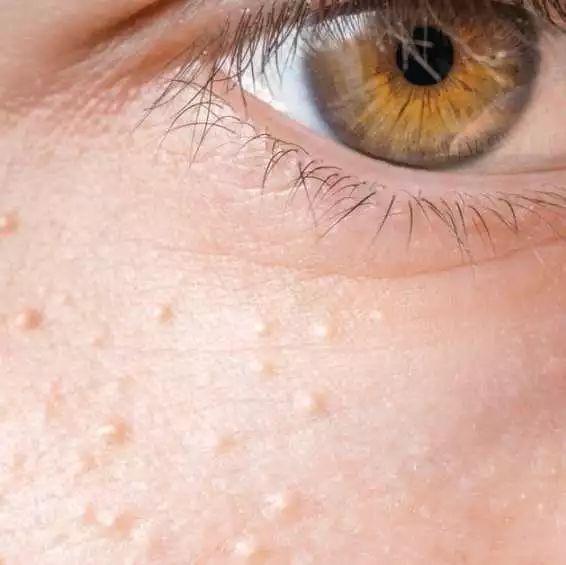 有没有人用眼霜黑眼圈更严重,黑眼圈用了眼霜过段时间就废了